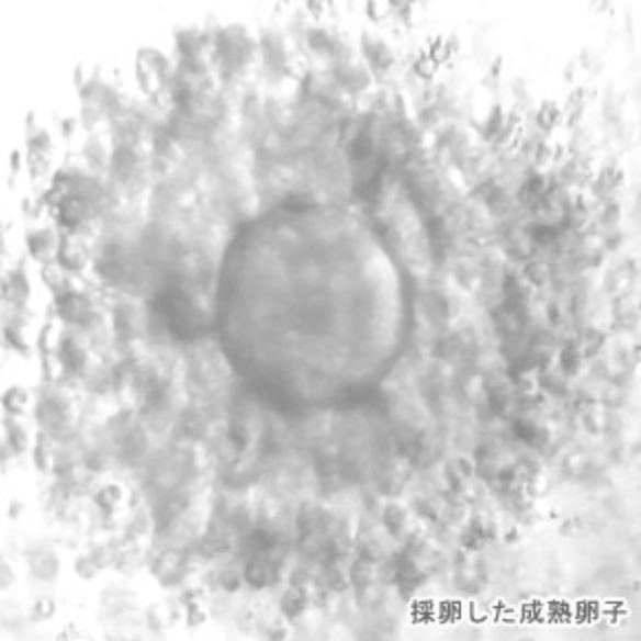 卵子採取の様子2